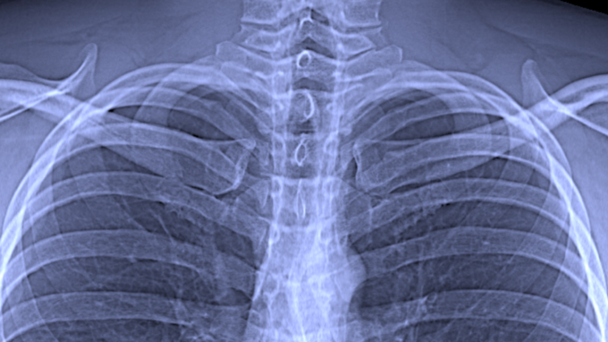 Ausschnitt aus einer konventionellen Röntgenaufnahme des Brustkorbs
